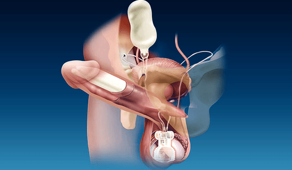 silicone thickness fillers and gel